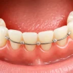 Permanent Retainer Guide: Benefits, Cost & Care