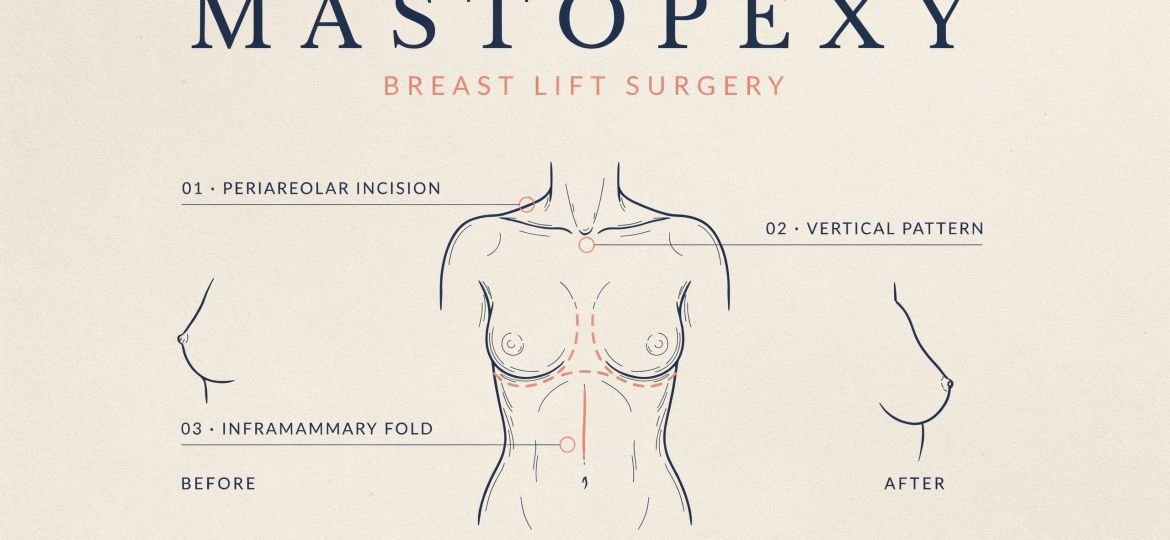Mastopexy Guide: Benefits, Procedure & Recovery