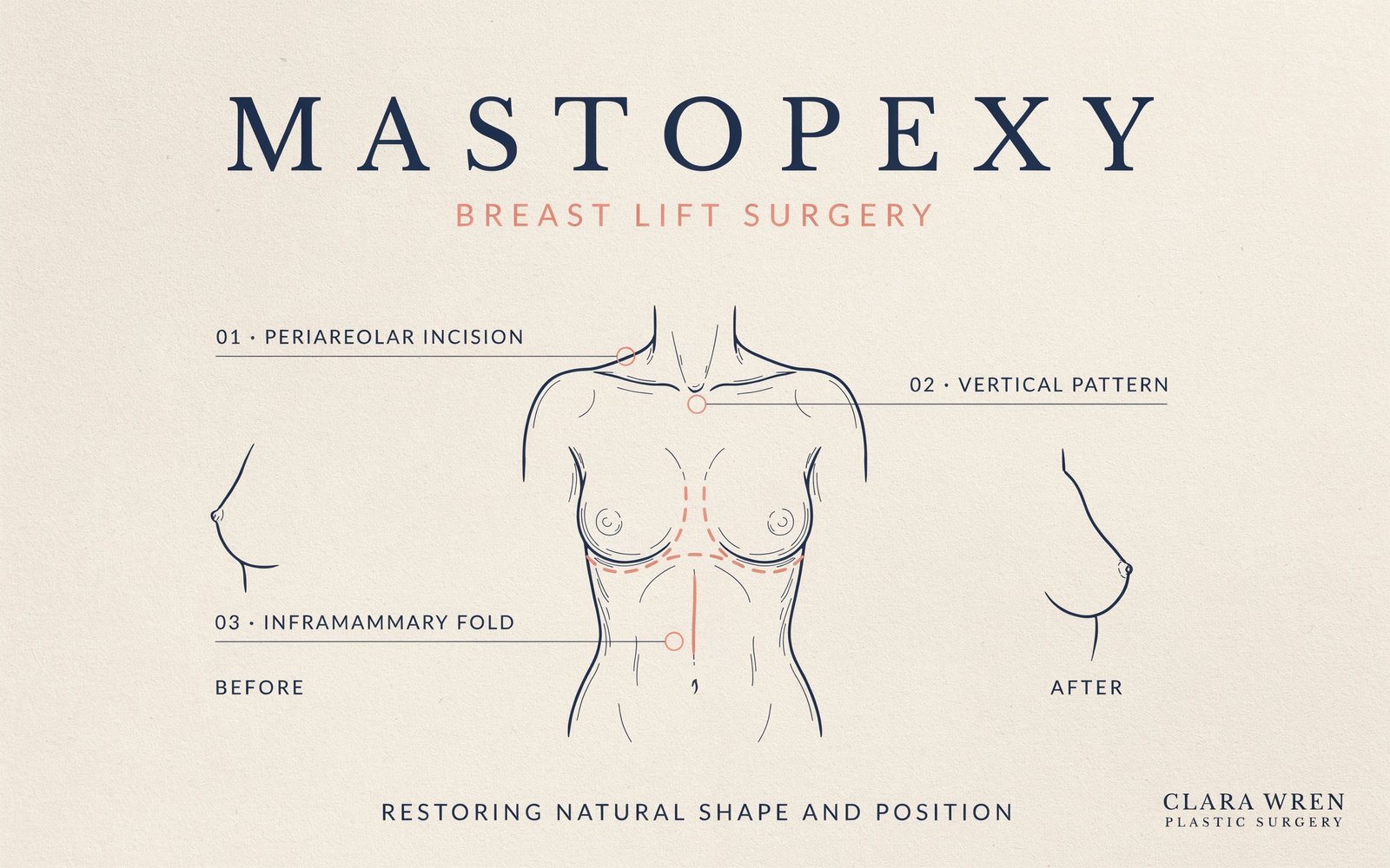 mastopexy-a-complete-guide-to-breast-lift-surgery