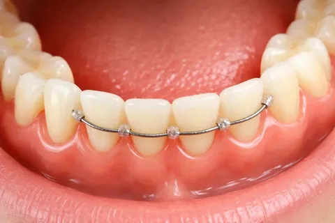 permanent-retainer-complete-teeth-alignment