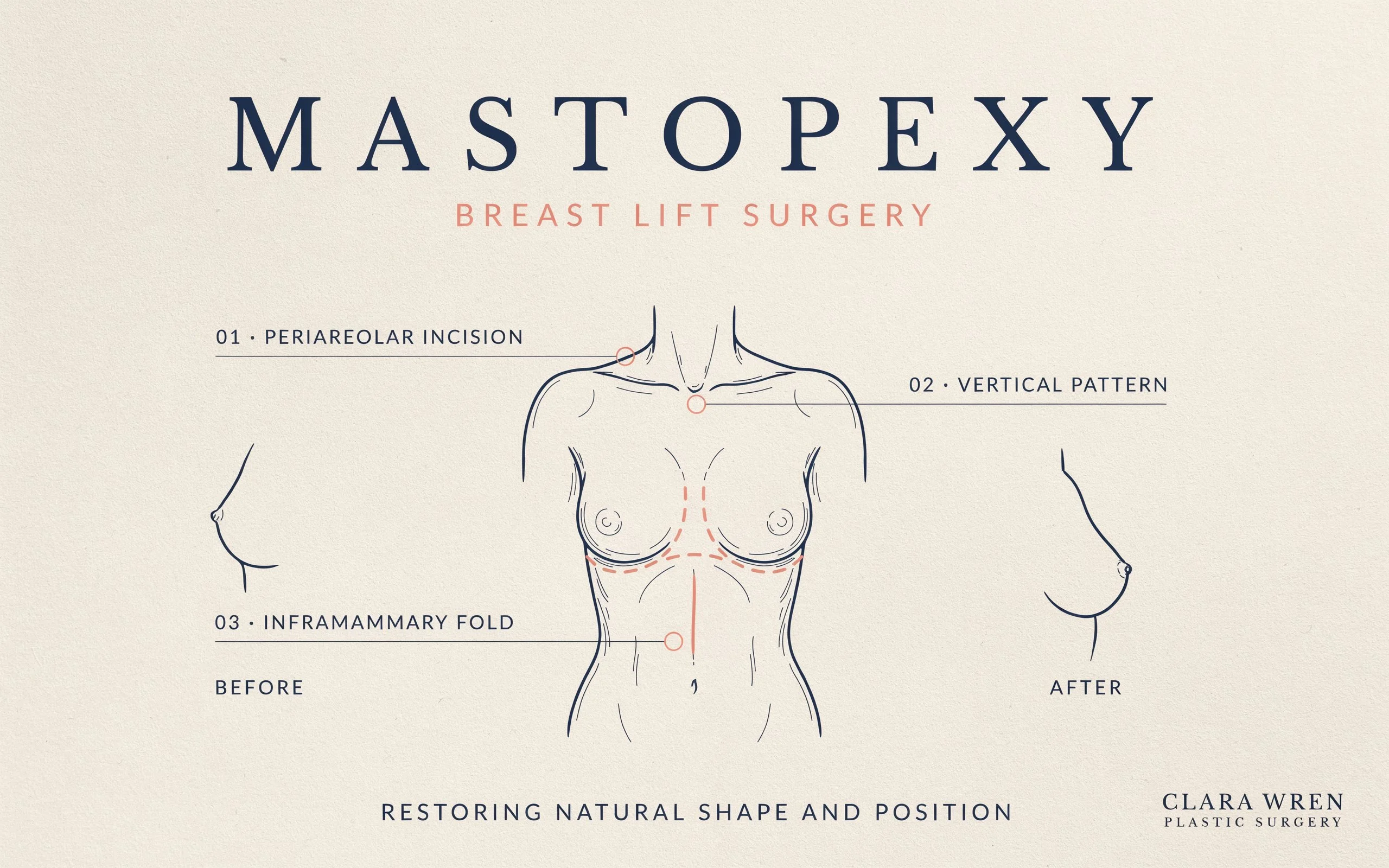 mastopexy-a-complete-guide-to-breast-lift-surgery